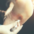 Understanding Neuropathy and Diabetes: A Comprehensive Guide for Foot Care in Los Angeles