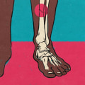 Understanding and Treating Stress Fractures in Los Angeles
