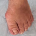 Understanding Bunions: Causes, Symptoms, and Treatment Options