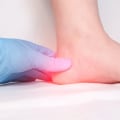 Understanding Plantar Fasciitis: Causes, Symptoms, and Treatment Options