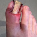 Understanding the Symptoms of Ingrown Toenails