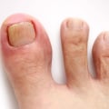 Treatment Options for Ingrown Toenails: Relieving Pain and Improving Foot Health