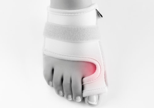 Treatment Options for Bunions: A Comprehensive Guide
