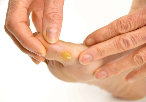 Plantar Wart vs Corn: Understand the Difference and Get the Right Diagnosis Fast