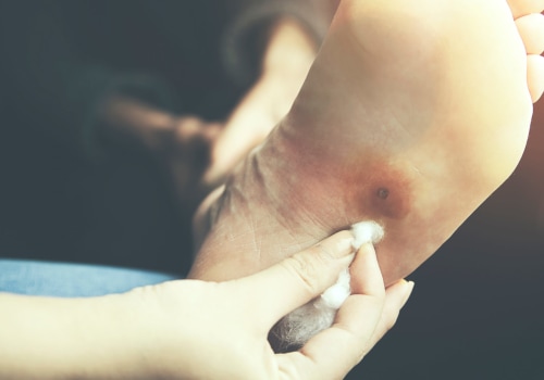 Understanding Neuropathy and Diabetes: A Comprehensive Guide for Foot Care in Los Angeles