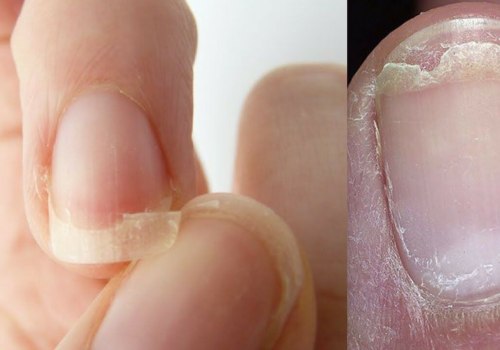 Understanding Common Nail Problems and Treatments