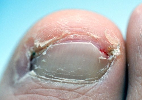 Causes of Ingrown Toenails: Understanding and Prevention