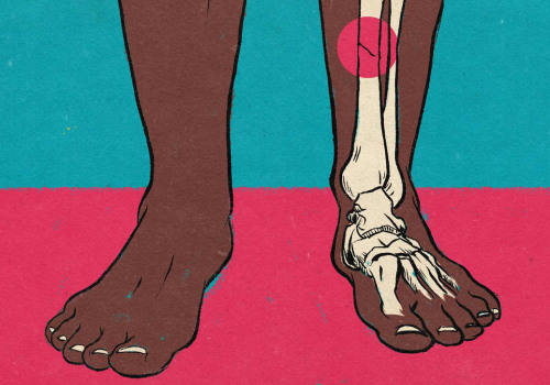 Understanding and Treating Stress Fractures in Los Angeles