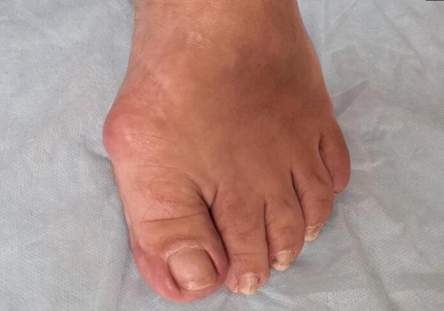 Understanding Bunions: Causes, Symptoms, and Treatment Options