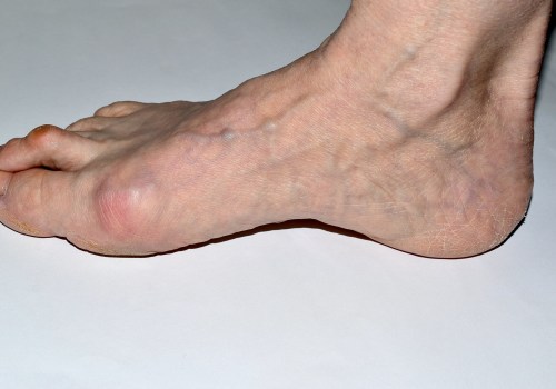 Causes of Bunions: Understanding Foot Pain and Seeking the Right Podiatrist in Los Angeles