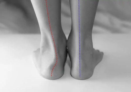 Supination vs. Pronation of the Foot: Understanding the Key Differences, Causes, and Best Treatment