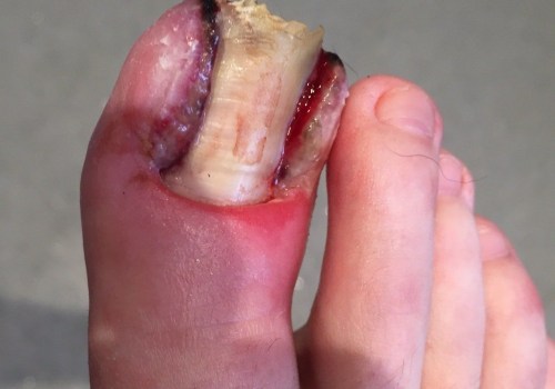 Understanding the Symptoms of Ingrown Toenails