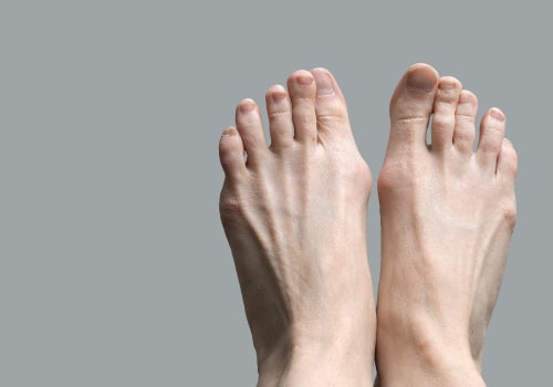 Foot Pain or Genetics? Causes of Claw Toe Deformity Uncovered
