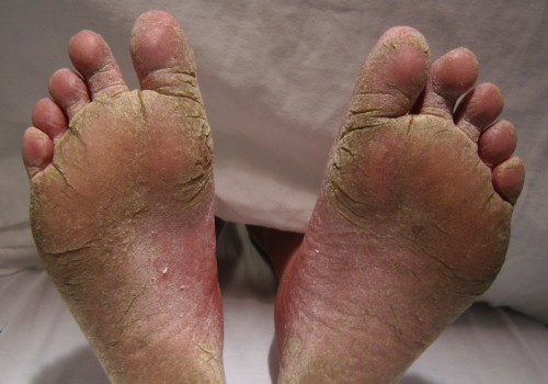 Preventing and Treating Fungal Infections: A Guide to Foot Care Services in Los Angeles
