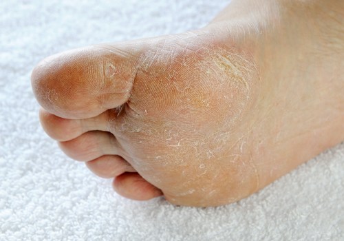 Understanding the Different Types of Arthritis that Affect the Feet
